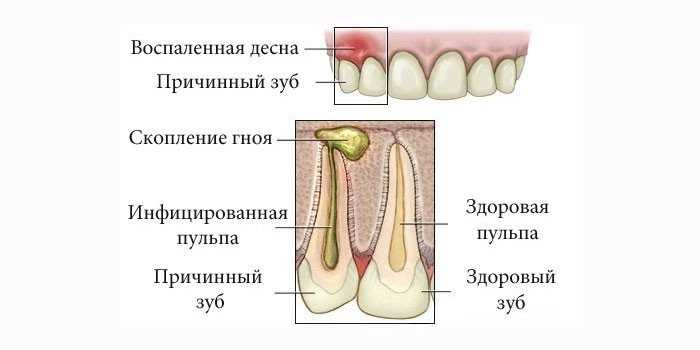 Сонник флюс на щеке, десне видеть во сне к чему снится