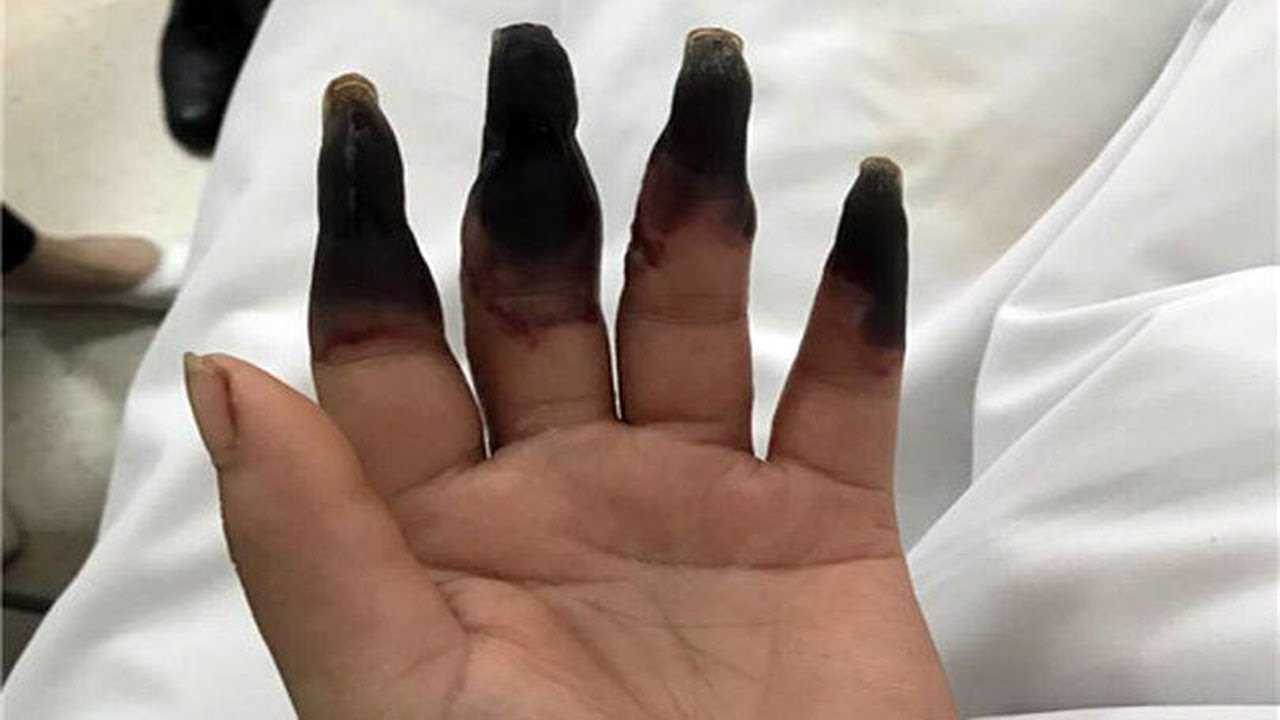 Раны во сне на теле: значение порезов ножом или укусов на руках, ладонях и ногах