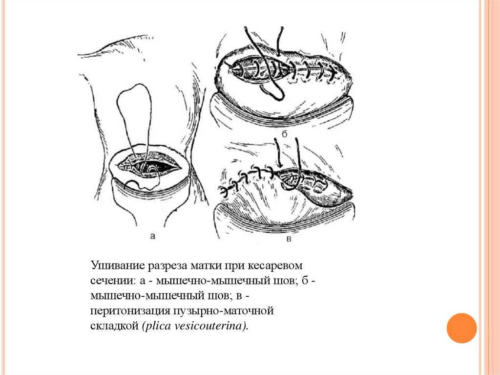 К чему снится кесарево сечение беременной