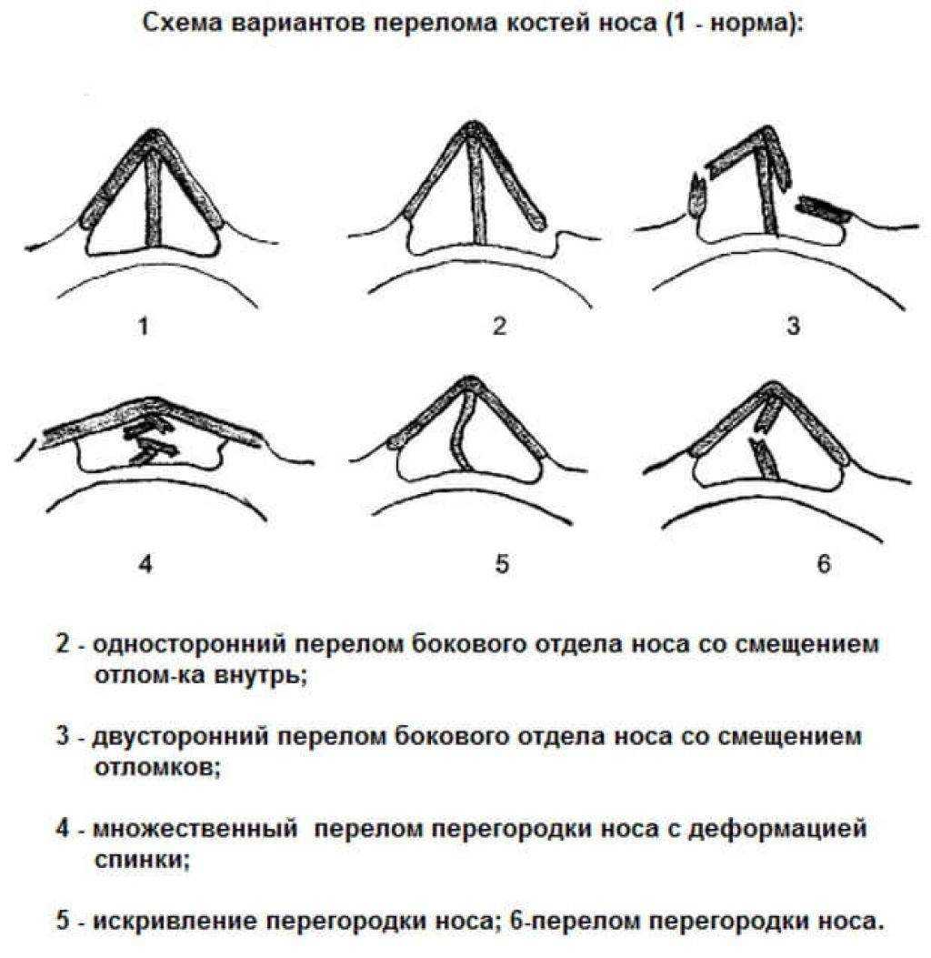 К чему снится нос - значение сна нос по соннику