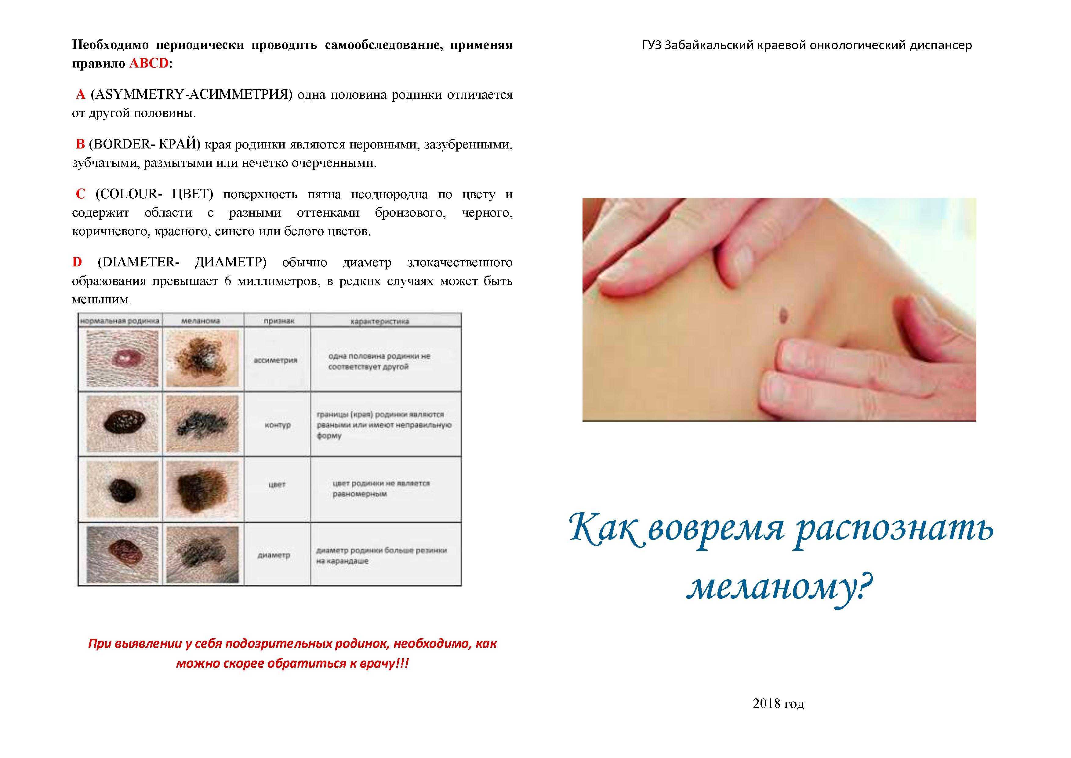 К чему снится большая родинка у себя на лице, на руке, на теле