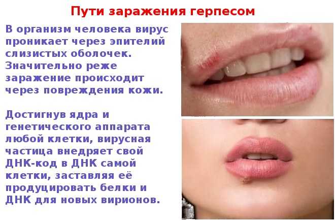 Герпес на губах сонник