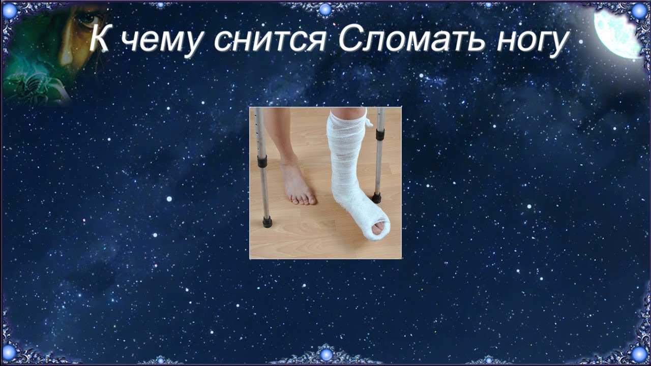 К чему снится перелом руки у другого