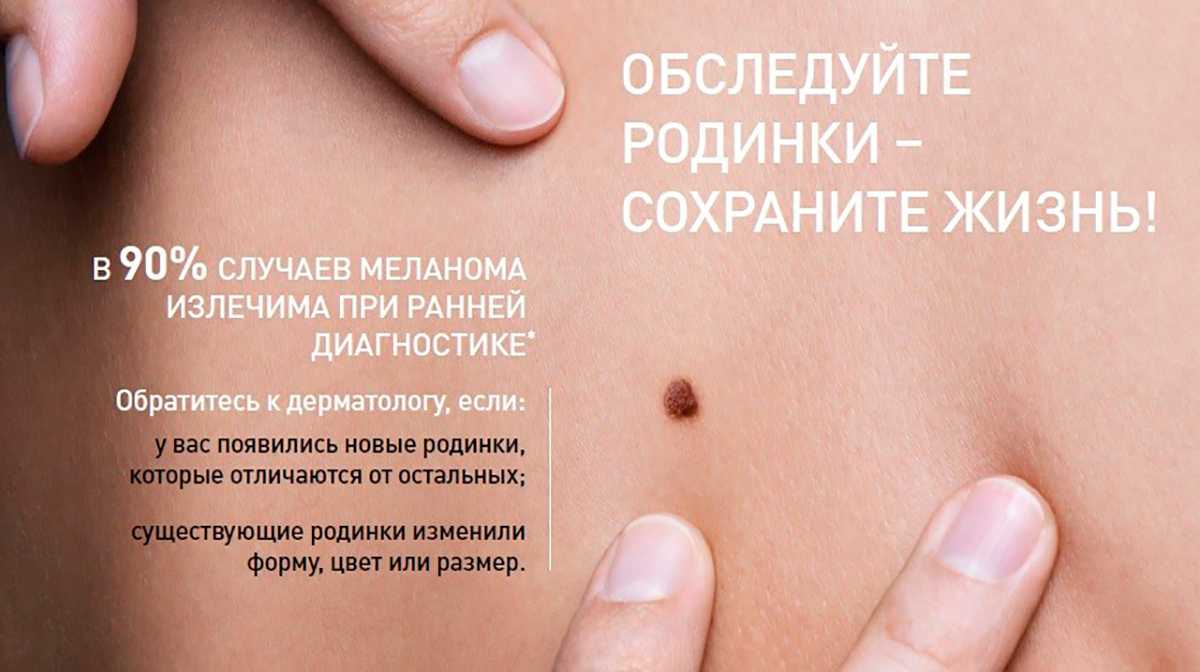 К чему снится родинка: значение и толкование, что предвещает сон