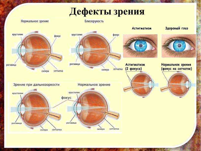 Дефекты глаз