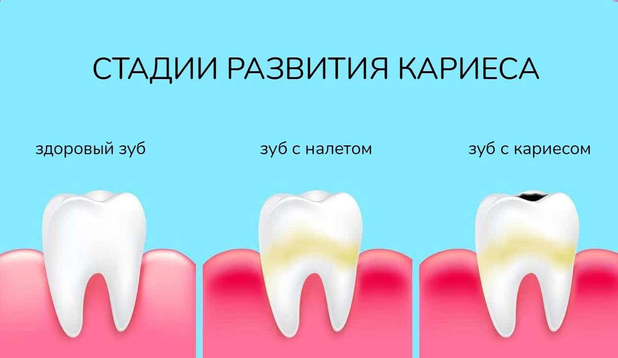 К чему снятся зубы с кариесом во рту у себя
