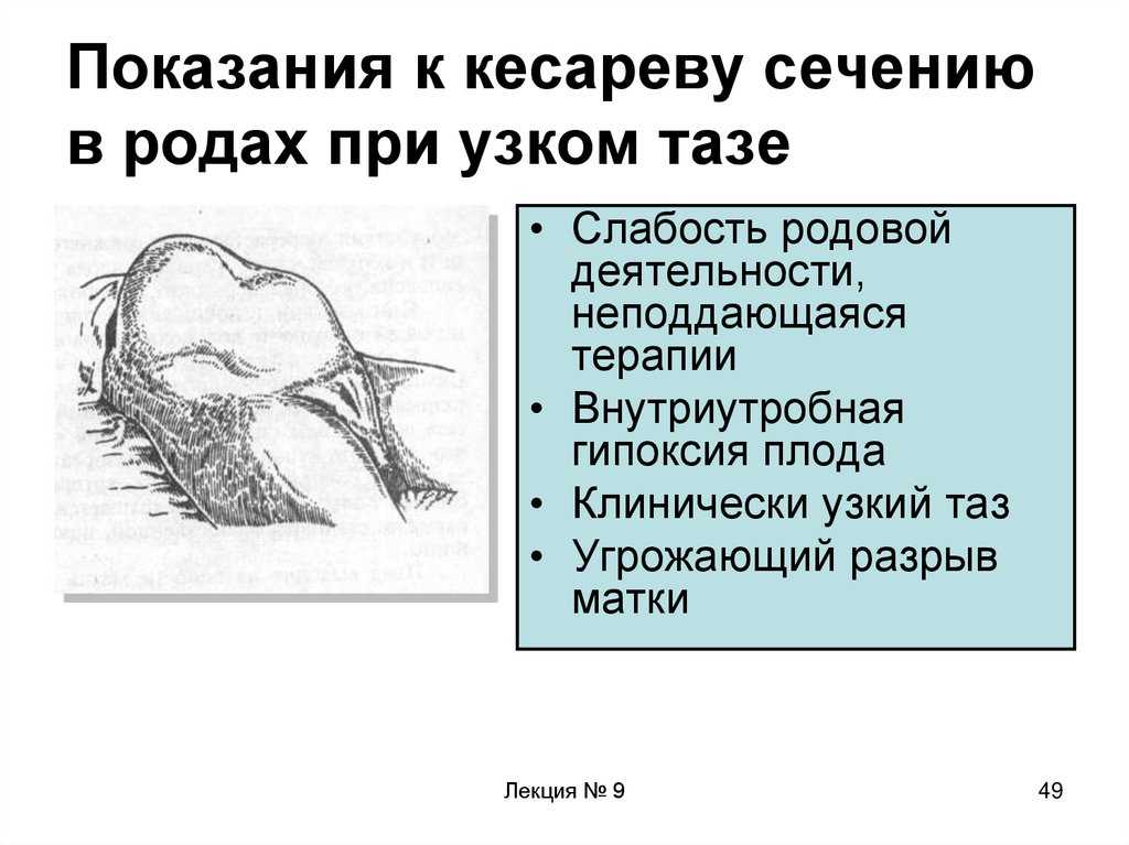 Сонник кесарево сечение к чему снится кесарево сечение во сне?
